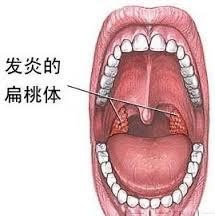 澳门专家解析，四个月宝宝扁桃体发炎的原因与应对之策