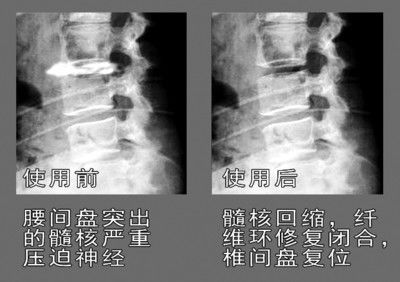 腰椎手术一个月后的恢复与康复策略，专家解读